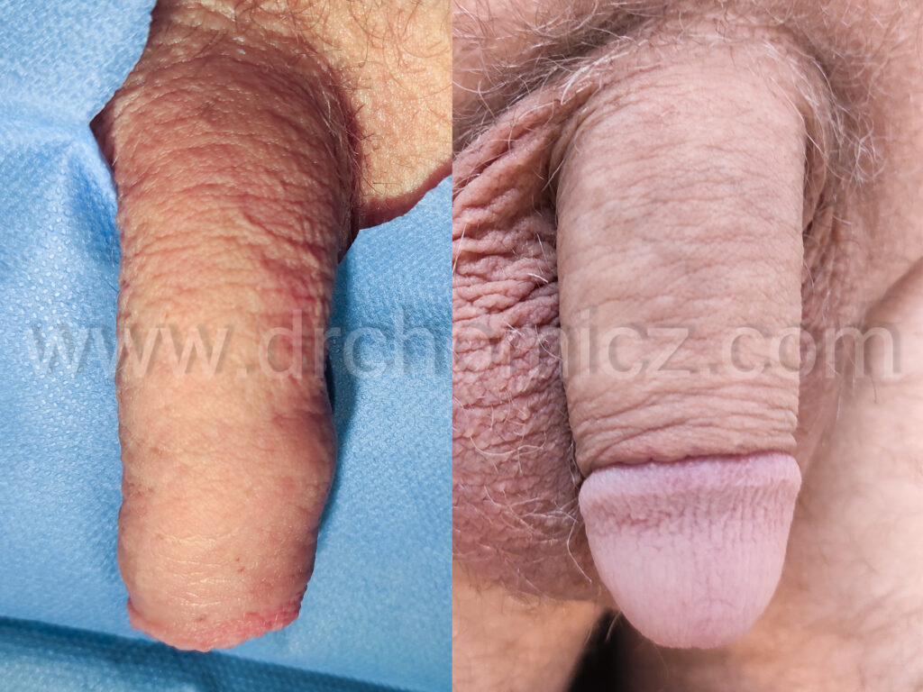 CC laser L&L (Low and Loose)