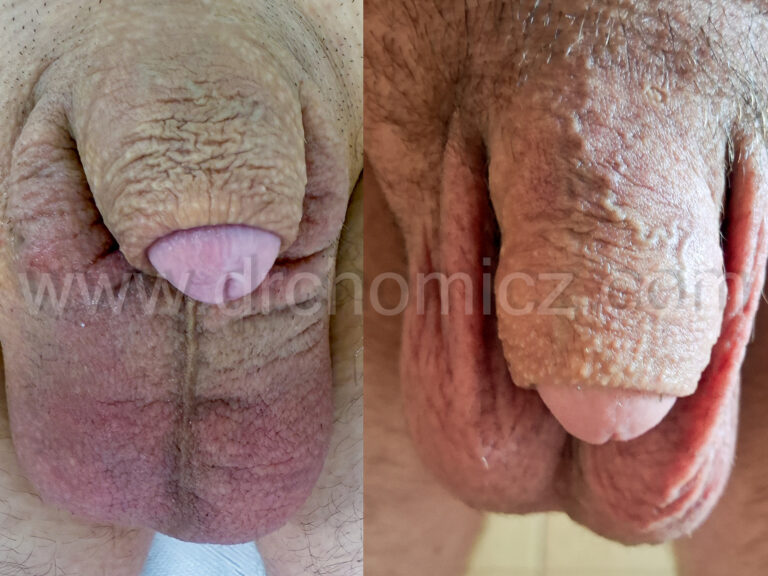 Powiększanie penisa toksyną botulinową.