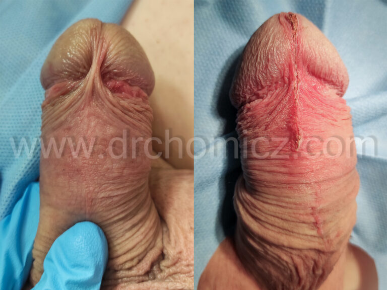 LASEROWA PLASTYKA KRÓTKIEGO WĘDZIDEŁKA PRĄCIA