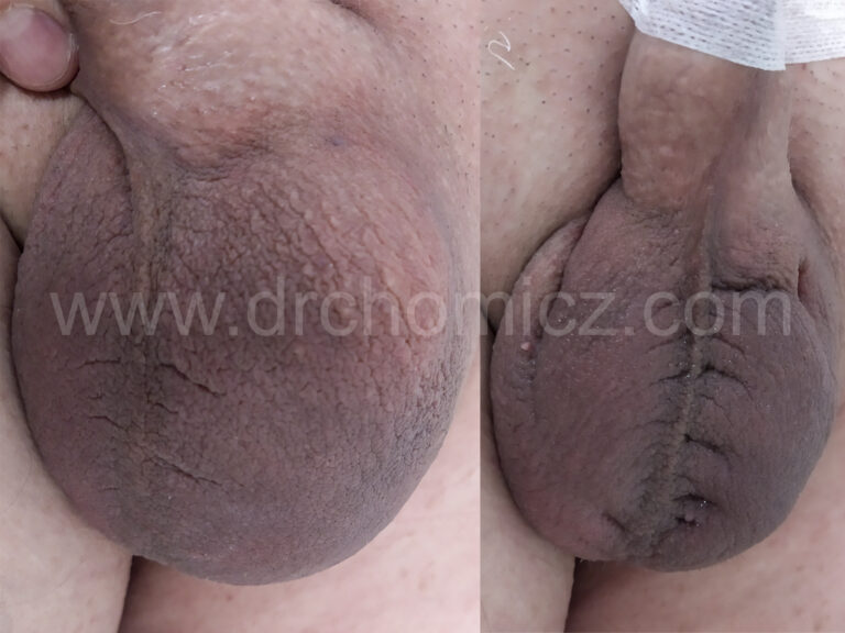 OPRÓŻNIENIE WODNIAKA JĄDRA LEWEGO. PUNKCJA PO KONTROLĄ USG