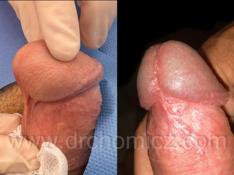 LASEROWA PLASTYKA KRÓTKIEGO WĘDZIDEŁKA PRĄCIA