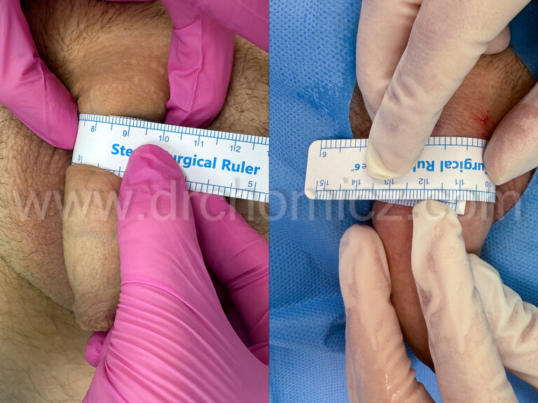 PRZED/PO. Powiększanie trzonu nieobrzezanego prącia kwasem hialuronowym 10ml + Bocox.