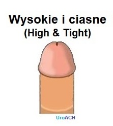 Obrzezanie estetyczne wysokie i ciasne ( High&Tight), Agnieszka Chomicz, Uroandrolog, AndroClinic